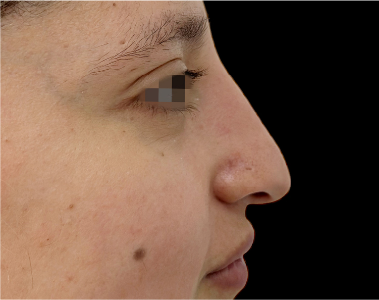 Recurso 18Rinoplastia Recurso 18Rinoplastia