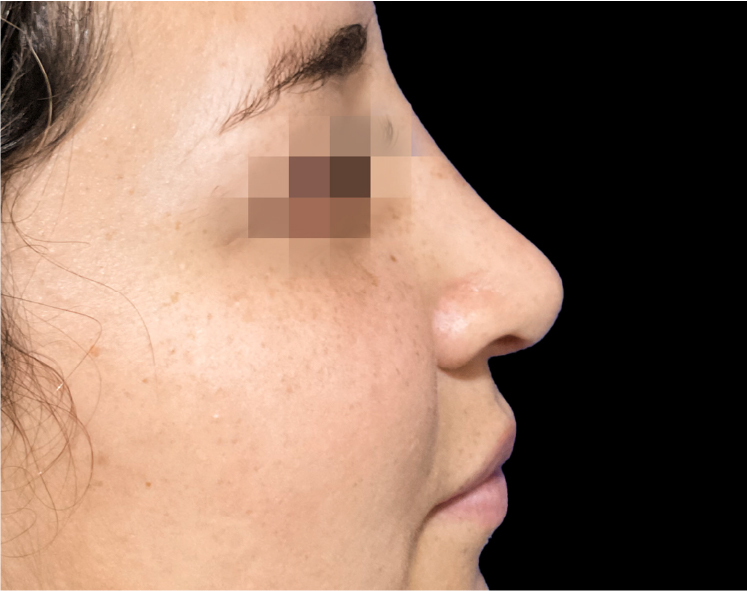 Recurso 19Rinoplastia Recurso 19Rinoplastia