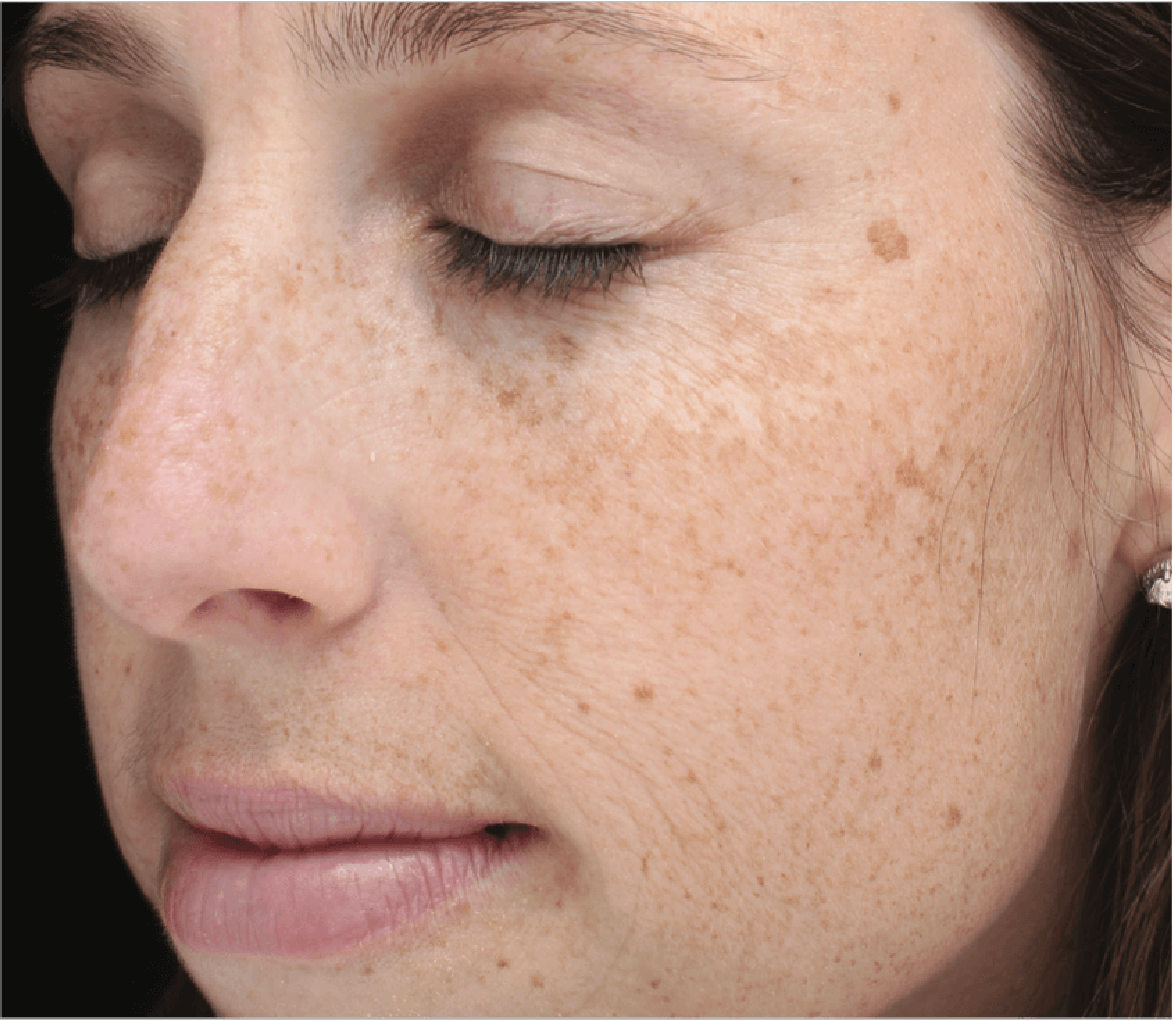 Tratamiento Manchas Rostro