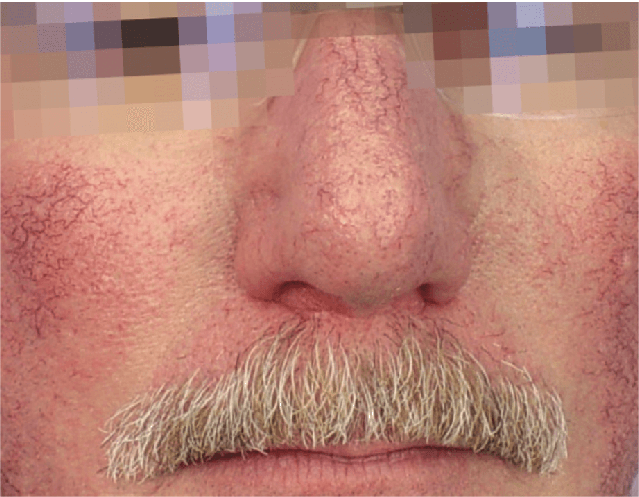 Lesiones Vasculares Rostro tratamientos esteticos Lesiones Vasculares Rostro