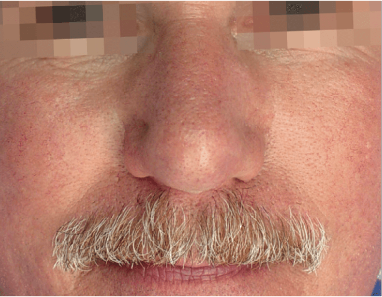 Lesiones Vasculares Rostro tratamientos esteticos Lesiones Vasculares Rostro