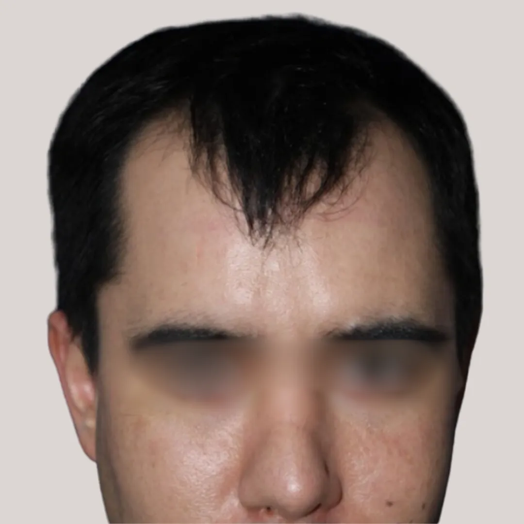 Antes-1 (1)