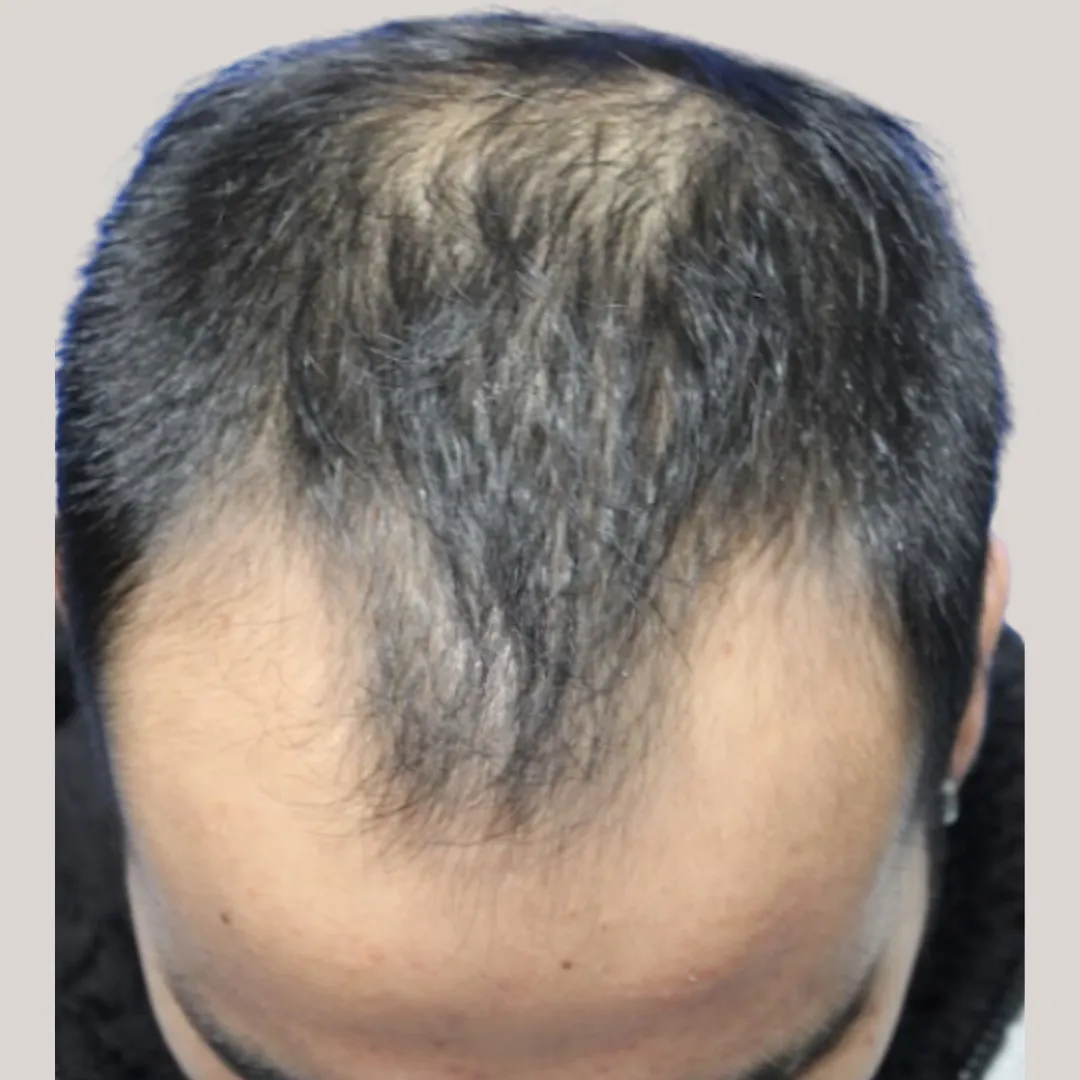 Antes (2)